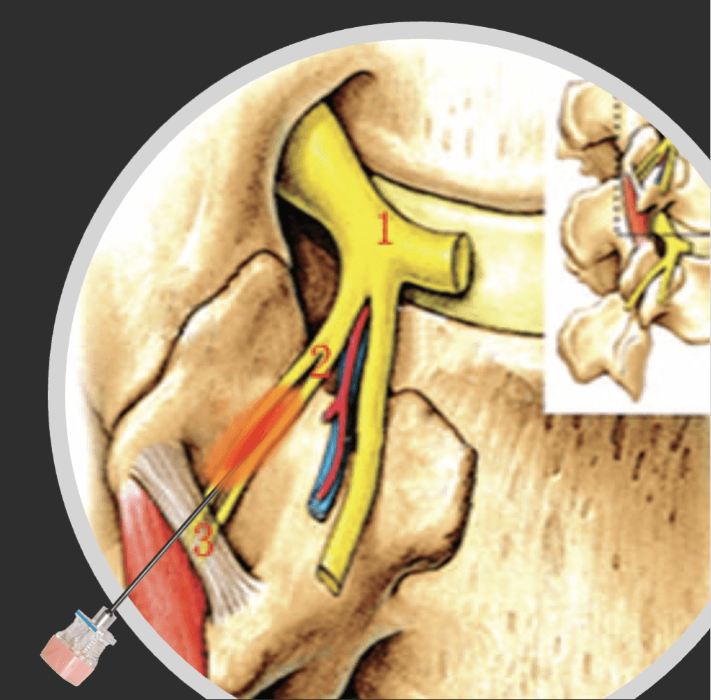Diagnostic Medial Branch Block