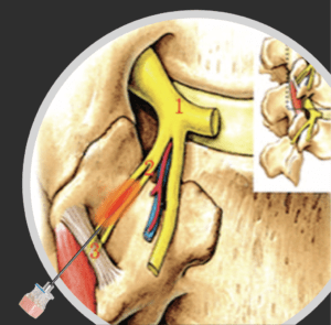 Diagnostic Medial Branch Block Diagnostic Medial Branch Block